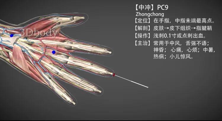 中冲穴的功效与作用（中冲穴—泻热开窍治疗昏厥）